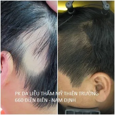 Hình ảnh : trước và sau khi khách hàng điều trị
