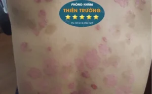 Hình ảnh: Vảy nến mảng tương đối phổ biến