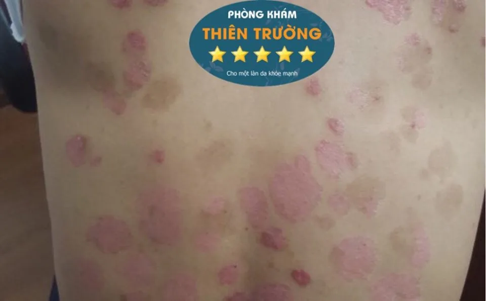Hình ảnh: Vảy nến mảng tương đối phổ biến