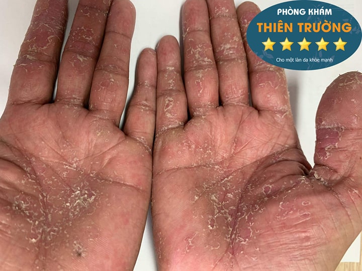 Hình ảnh: Viêm da tiếp xúc ở tay