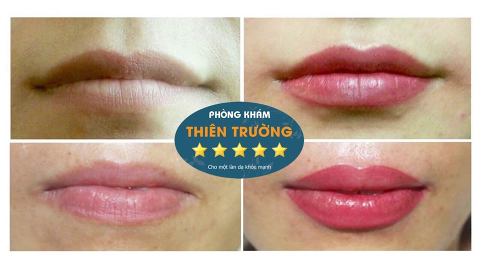 Hình ảnh: Khách hàng sau khi phun môi công nghệ châu âu