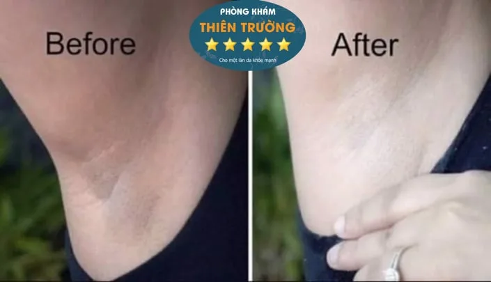 Hình ảnh: Trước và sau hỗ trợ điều trị thâm nách 