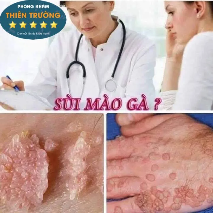 Hình ảnh: Biểu hiện bệnh sùi mào gà