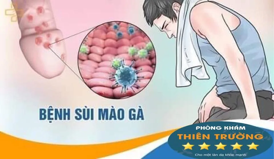 Hình ảnh: Sùi mào gà