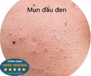 Hình ảnh: Mụn đầu đen.