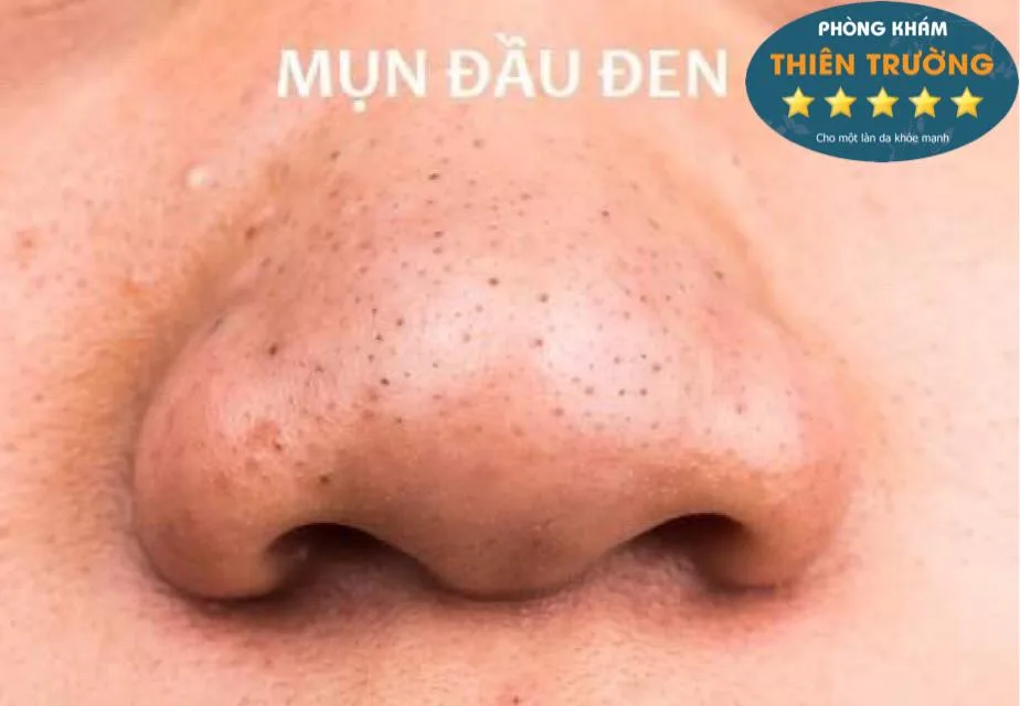 Hình ảnh: Mụn đầu đen ở mũi