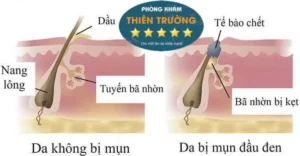 Hình ảnh: Quá trình hình thành mụn đầu đen