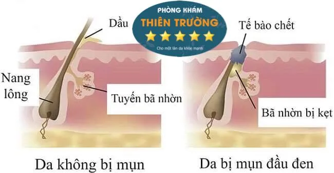Hình ảnh: Quá trình hình thành mụn đầu đen