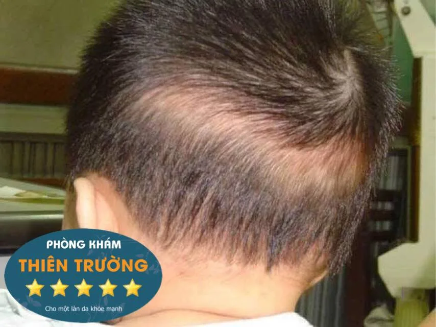 Hình ảnh: Trẻ bị rụng tóc vành khăn