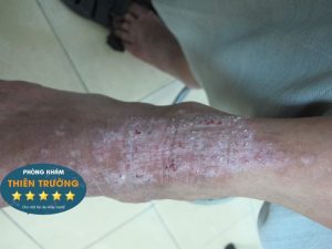 Hình ảnh: Viêm da cơ địa ở chân