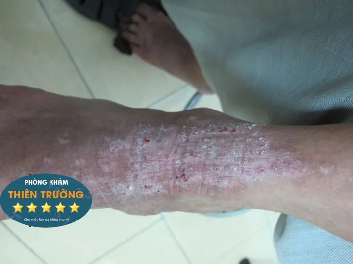 Hình ảnh: Viêm da cơ địa ở chân