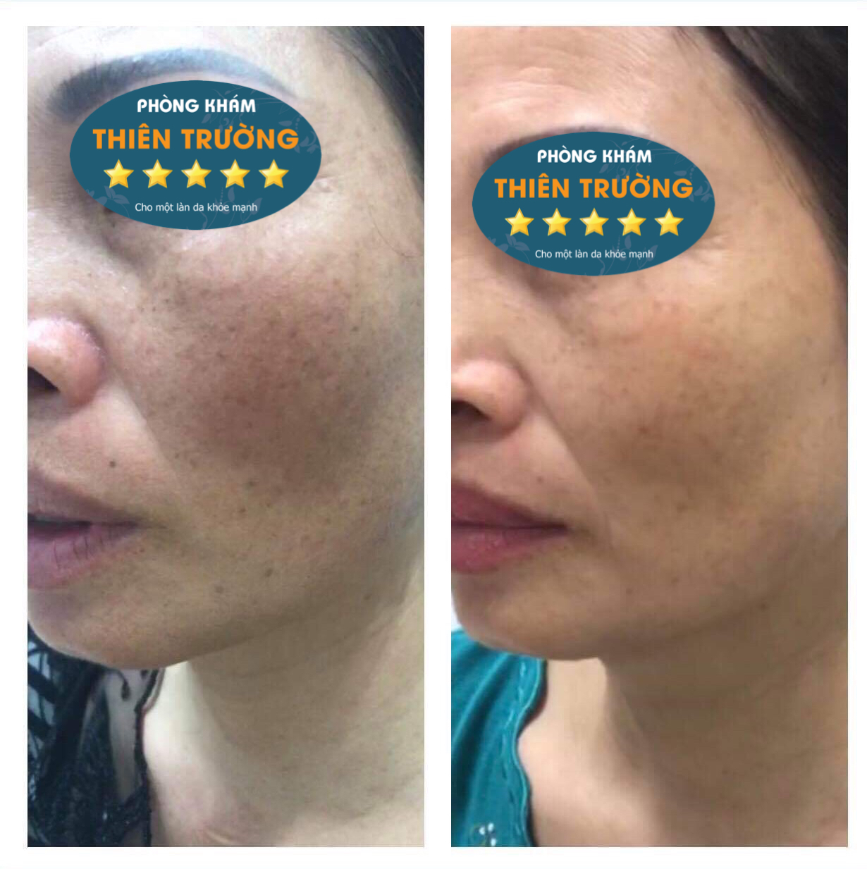 Hình ảnh: Trước và sau 5 buổi điều trị nám bằng Laser Picosure
