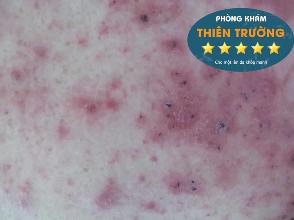 Hình ảnh: Viêm da cơ địa phóng to