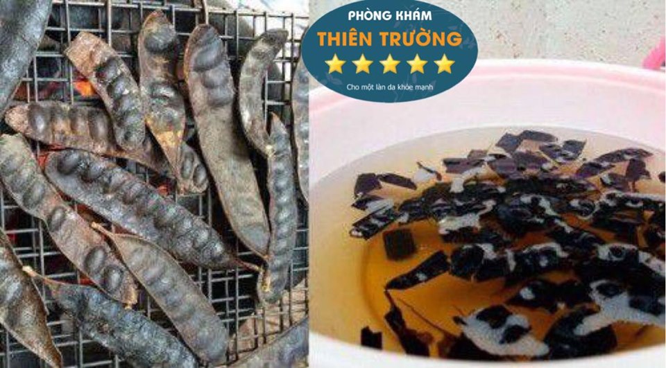 Hình ảnh: Hỗ trợ điều trị bệnh nấm da đầu bằng bồ kết