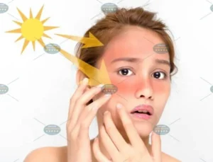 Hình ảnh : Ánh nắng mặt trời gây nám da