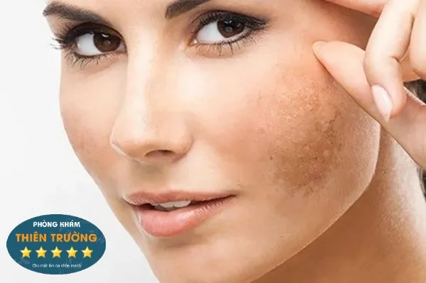 Hình ảnh : Nám da