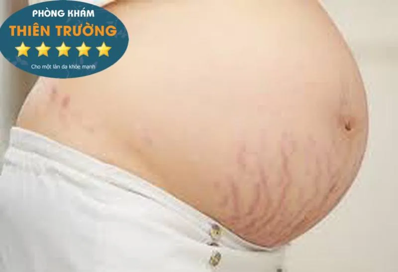 Hình ảnh: Rạn da khi mang bầu