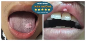 Hình ảnh: Sùi mào gà ở miệng