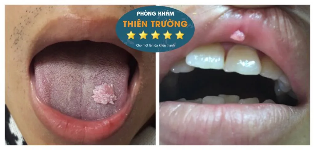 Hình ảnh: Sùi mào gà ở miệng