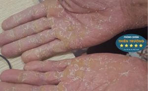 Hình ảnh: Viêm da cơ địa ở tay