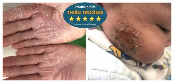 Hình ảnh: Dấu hiệu nhận biết viêm da cơ địa