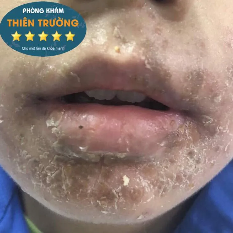 Hình ảnh: Viêm da cơ địa xung quanh miệng