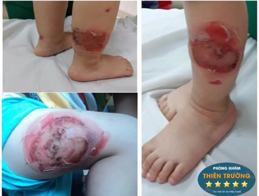 Hình ảnh: Chốc ở các vùng