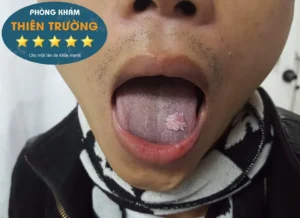 Hình ảnh: Sùi mào gà ở miệng