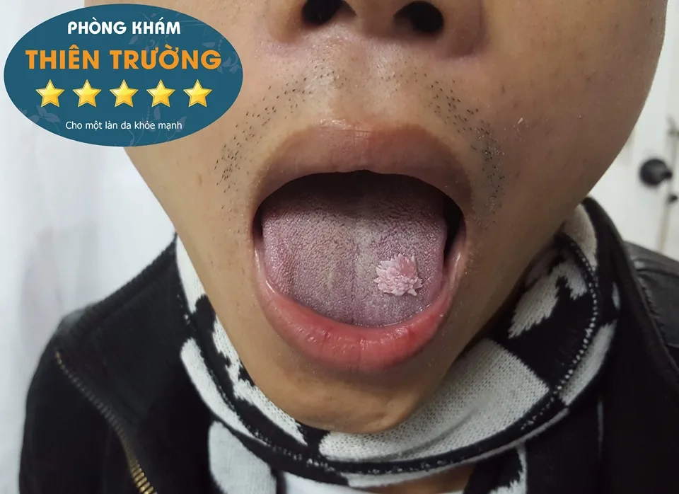 Hình ảnh: Sùi mào gà ở miệng