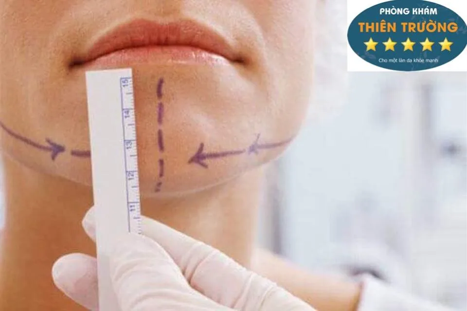 Hình ảnh: Thạc sĩ - Bác sĩ đang đánh dấu đường cần thực hiện trước khi thon gọn hàm không phẫu thuật