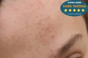 Hình ảnh: Mụn ẩn trên trán