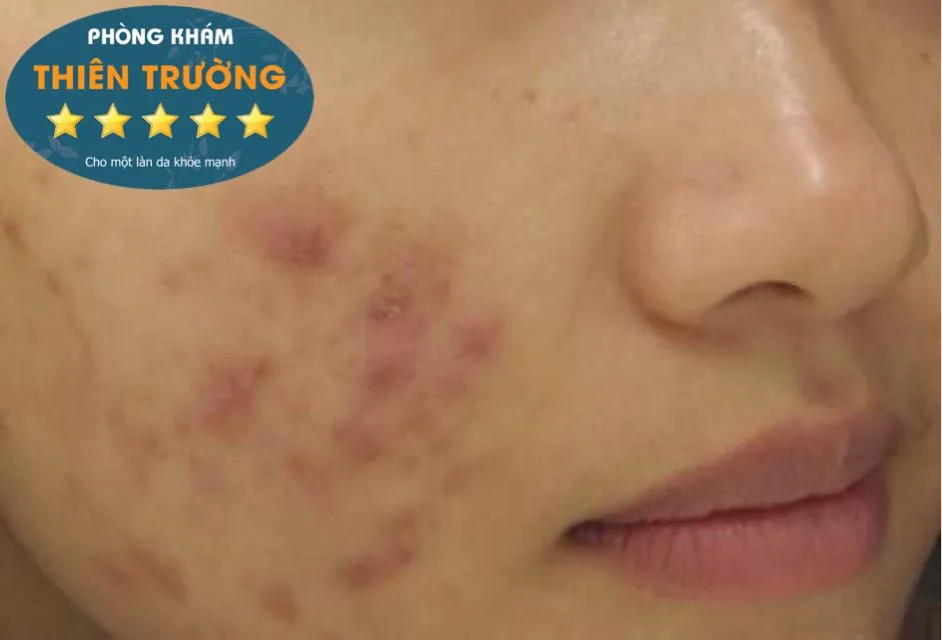 Hình ảnh: Mụn ở 2 má