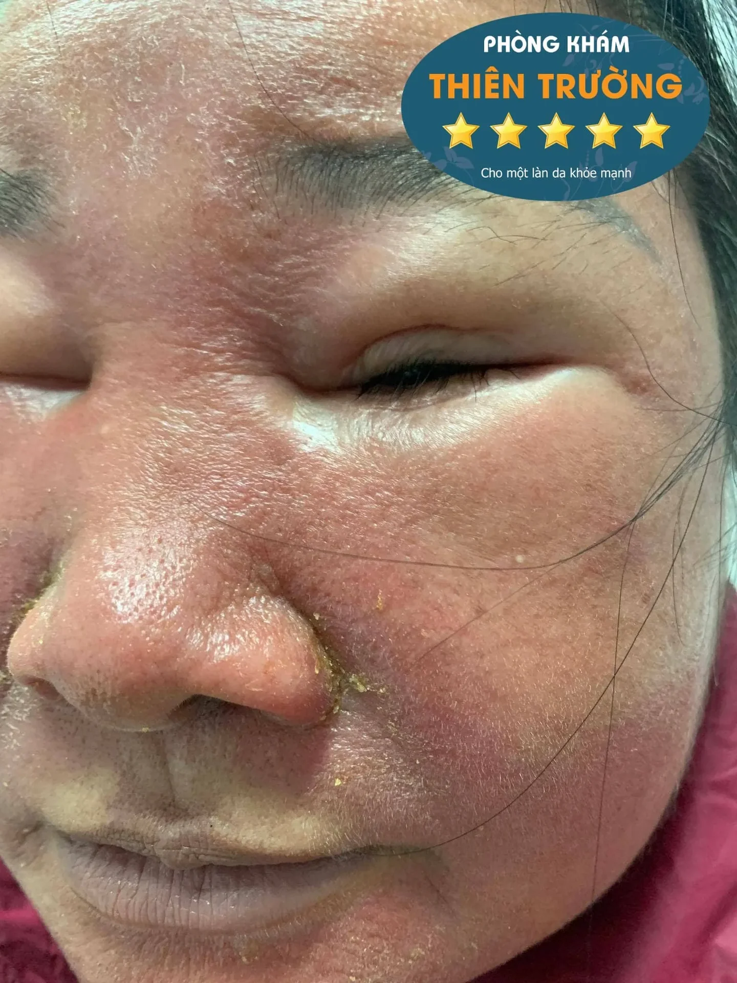 Hình ảnh: Viêm da