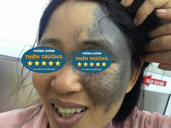 Hình ảnh: Bớt sắc tố trên mặt