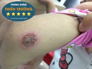 Hình ảnh: Chốc ở trẻ nhỏ