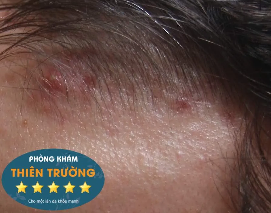 Hình ảnh: Mụn ở đường chân tóc và gần tai