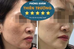 Hình ảnh: Trước và sau khi được hỗ trợ điều trị nám tàn nhang.