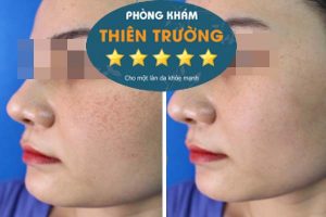 Hình ảnh: Nám tàn nhang