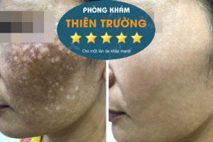 Hình ảnh: Trước và sau khi thực hiện xóa nhăn tại phòn gkhasm Da liễu-Thẩm mỹ Thiên trường.