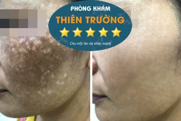 Hình ảnh: Trước và sau khi thực hiện xóa nhăn tại phòn gkhasm Da liễu-Thẩm mỹ Thiên trường.