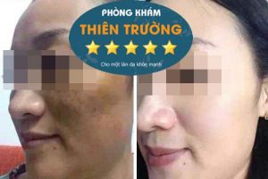 Hình ảnh: Trước và sau khi được hỗ trợ điều trị nám tại phòng khám Da liễu-Thẩm mỹ Thiên Trường