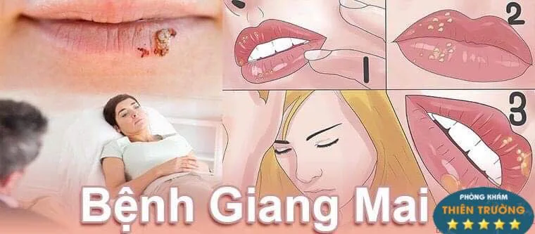 Hình ảnh: Bệnh giang mai 