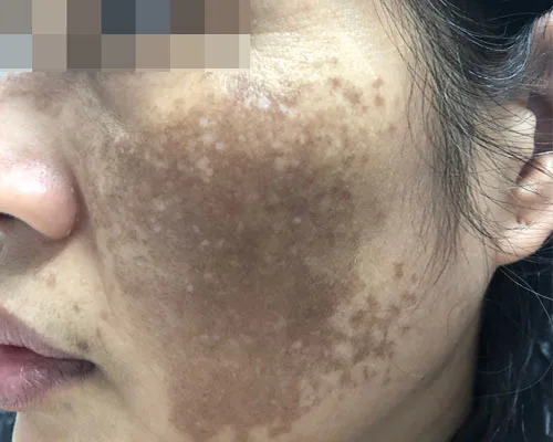 Hình ảnh: Nám da trên vùng mặt