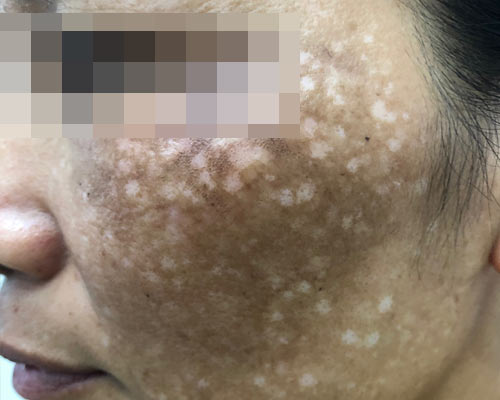 Hình ảnh: Nám da.