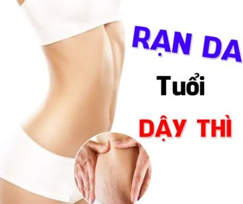 Hình ảnh: Rạn da tuổi dậy thì
