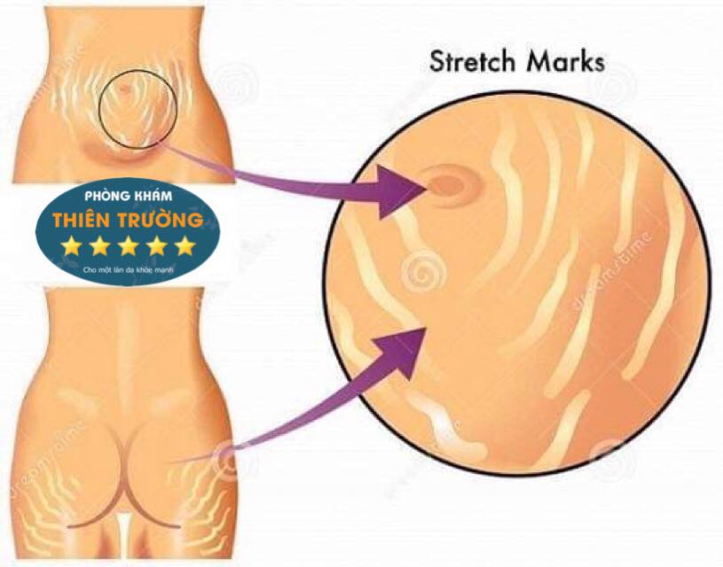 Hình ảnh: Rạn da