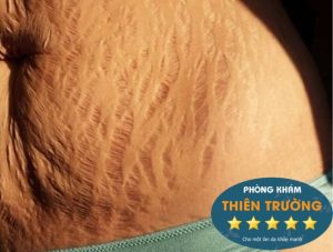 Hình ảnh: Rạn da vùng bụng