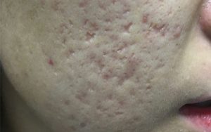 seo-lom-do-mun-trung-ca