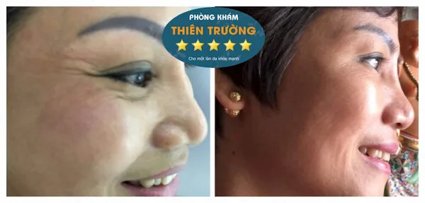 Hình ảnh: Trước và sau khi hỗ trợ điều trị xóa nhăn