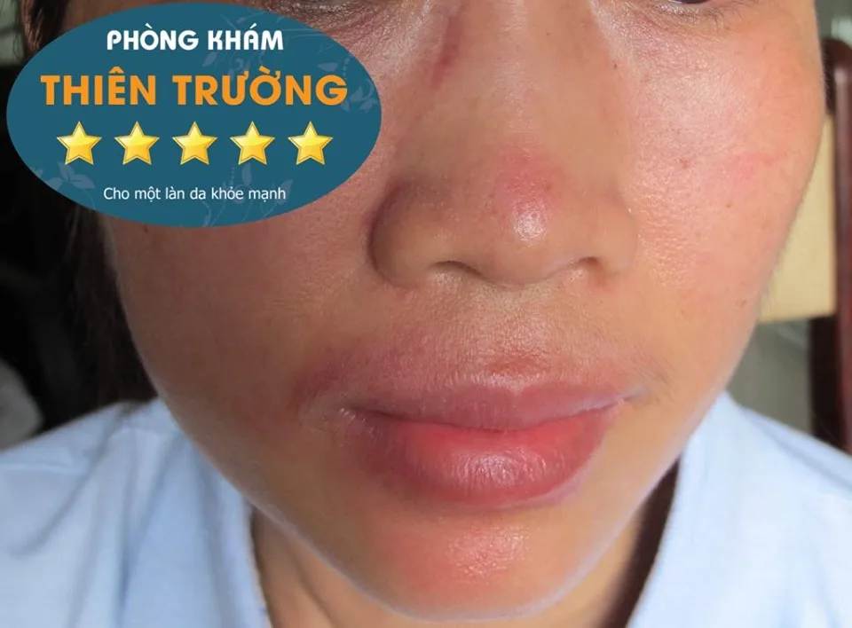 Hình ảnh: Viêm da cơ địa ở mặt